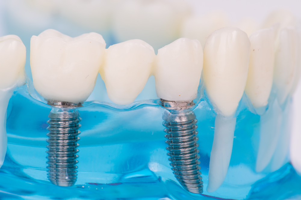 Implantodontia: O que é e como funciona?